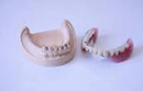 コーヌス義歯3